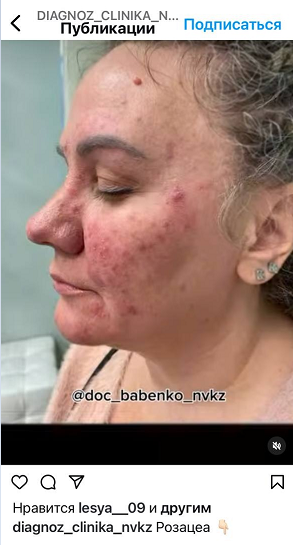 Женщина с признаками розацеа на лице – признак сомнительного контента